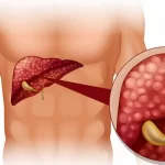 Best Liver Cancer Treatment in Chennai | CTS Hospitals