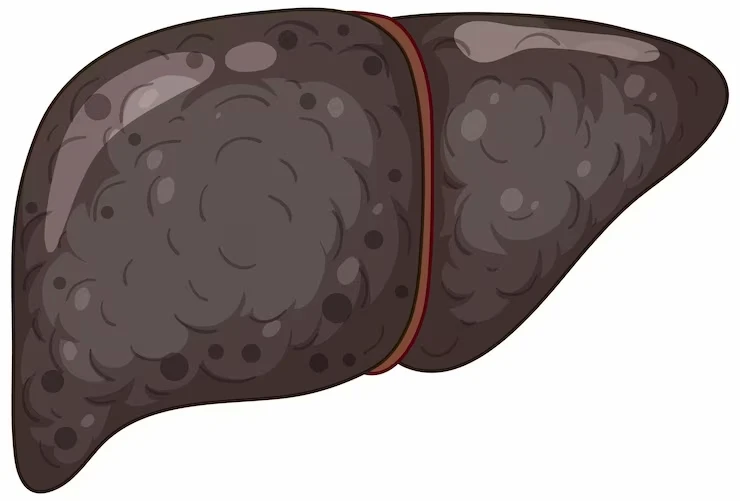 Chronic liver disease treatment in Chennai | CTS Hospitals