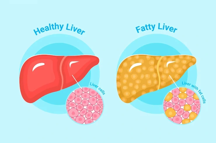 fatty liver specialist in Chennai | CTS Hospitals
