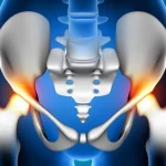 hip replacement surgery in Chennai | CST Hospitals