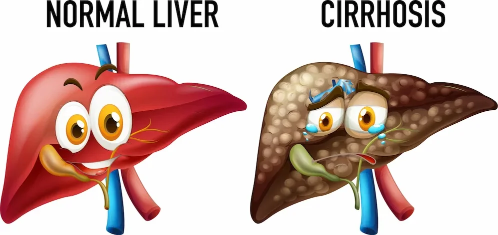 liver cirrhosis treatment in Chennai | CTS Hospitals
