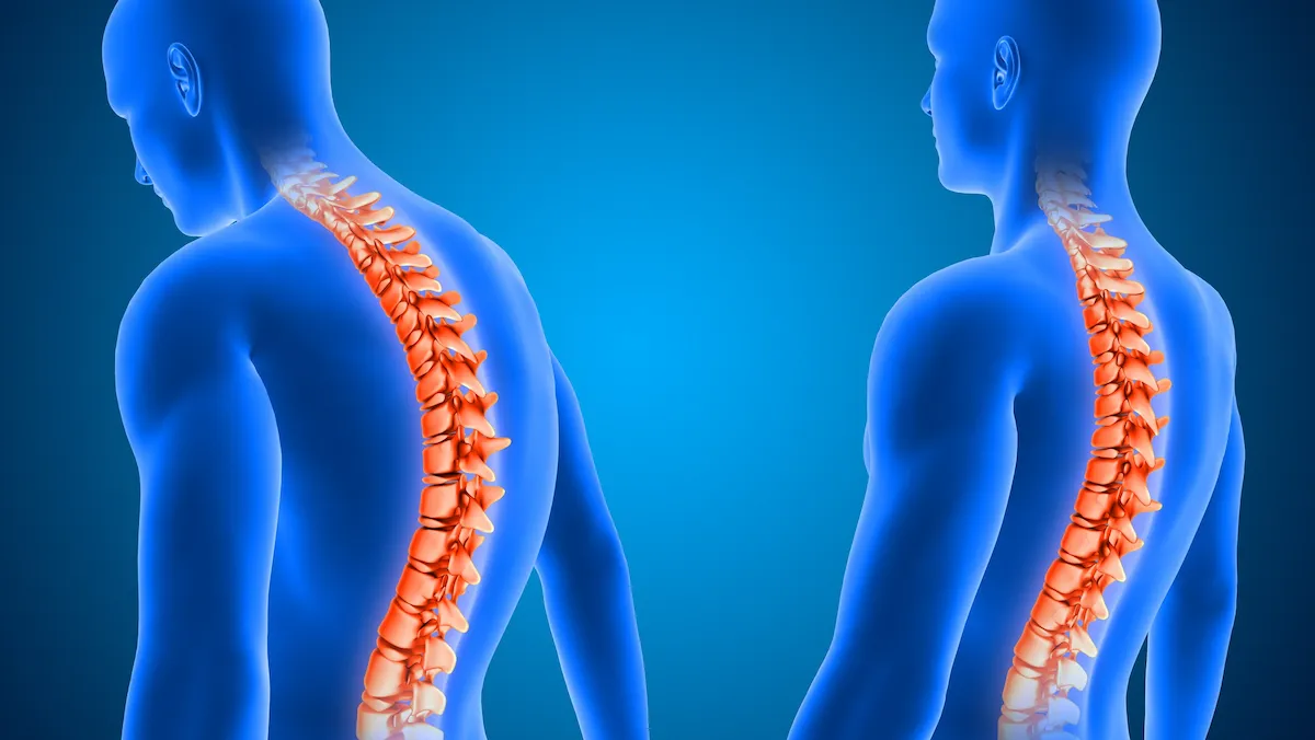 spine surgery in Chennai | CST Hospitals