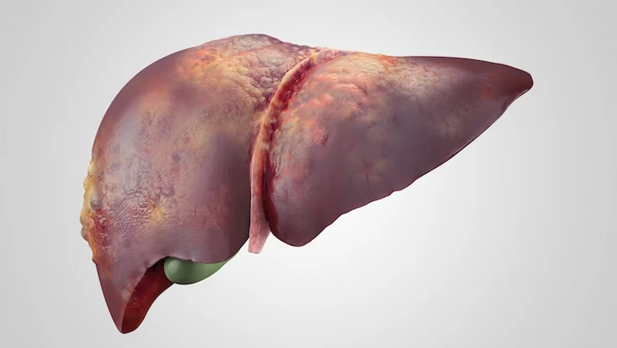 liver cirrhosis treatment in Chennai | CTS Hospitals