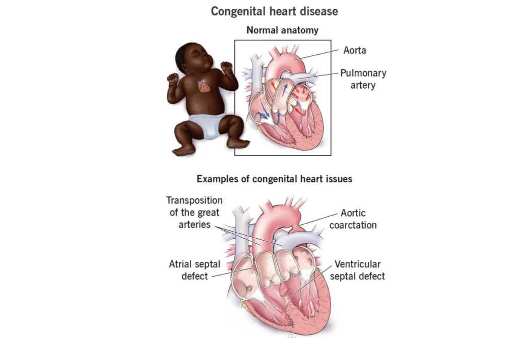 Congenital Heart Failure Treatment
