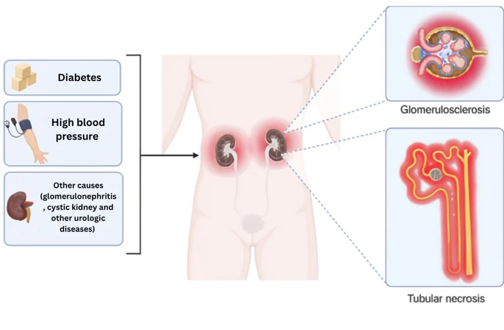 Hypertensive Nephropathy Treatment