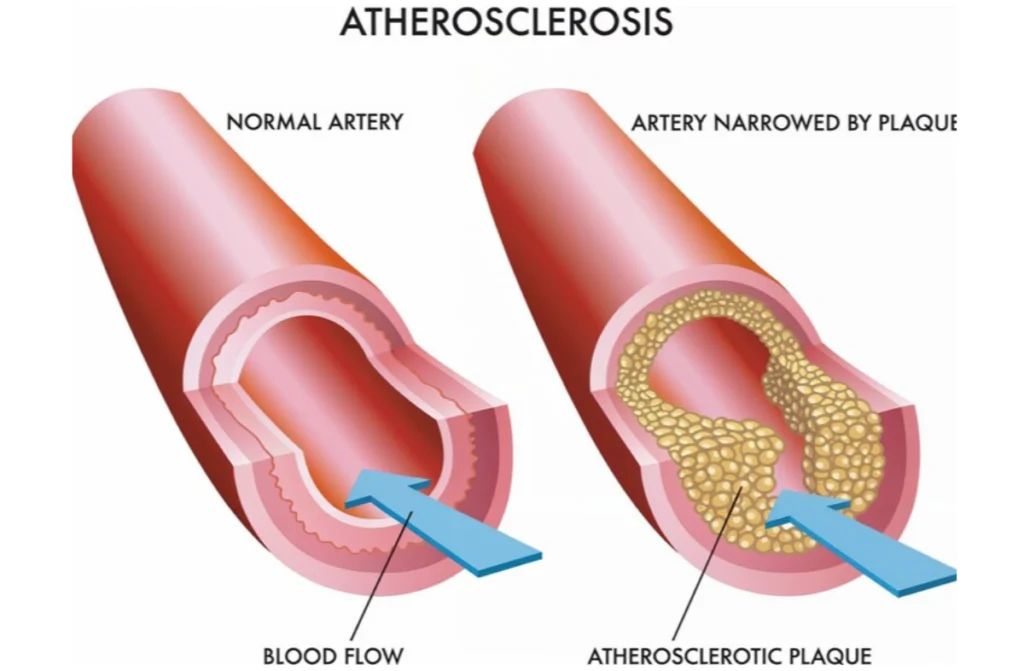 Natural Treatment For Arteriosclerosis