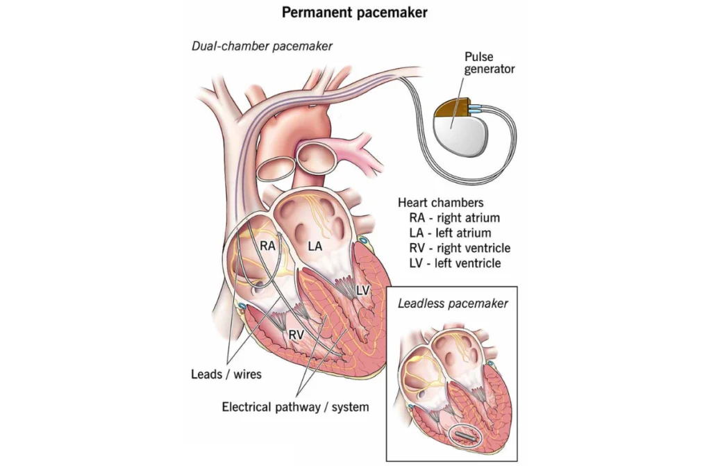 Permanent Pacemaker Implantation