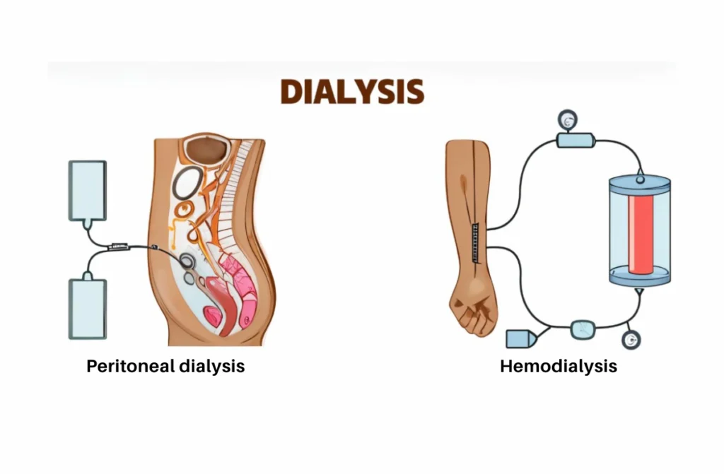 2 Types of Dialysis
