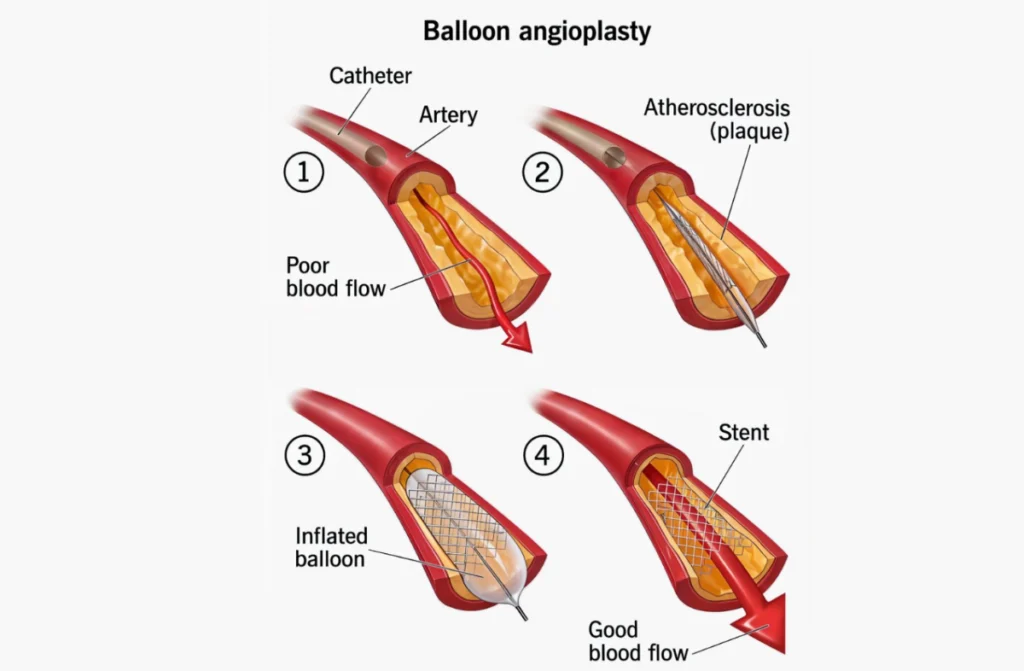 Angioplasty And Stent Placement