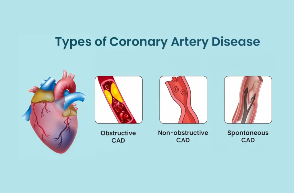 Coronary Artery Disease in Chennai