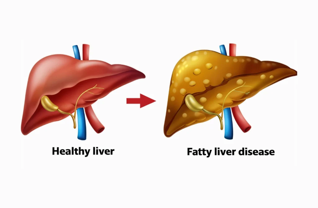 Fatty Liver While Pregnant