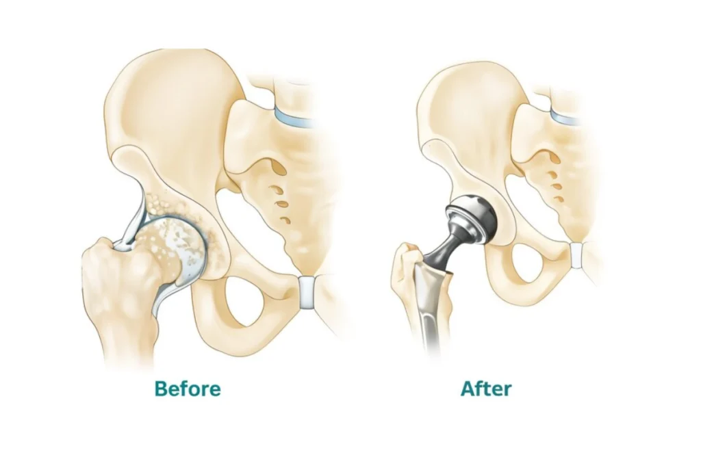 Hip Replacement Doctors in Chennai