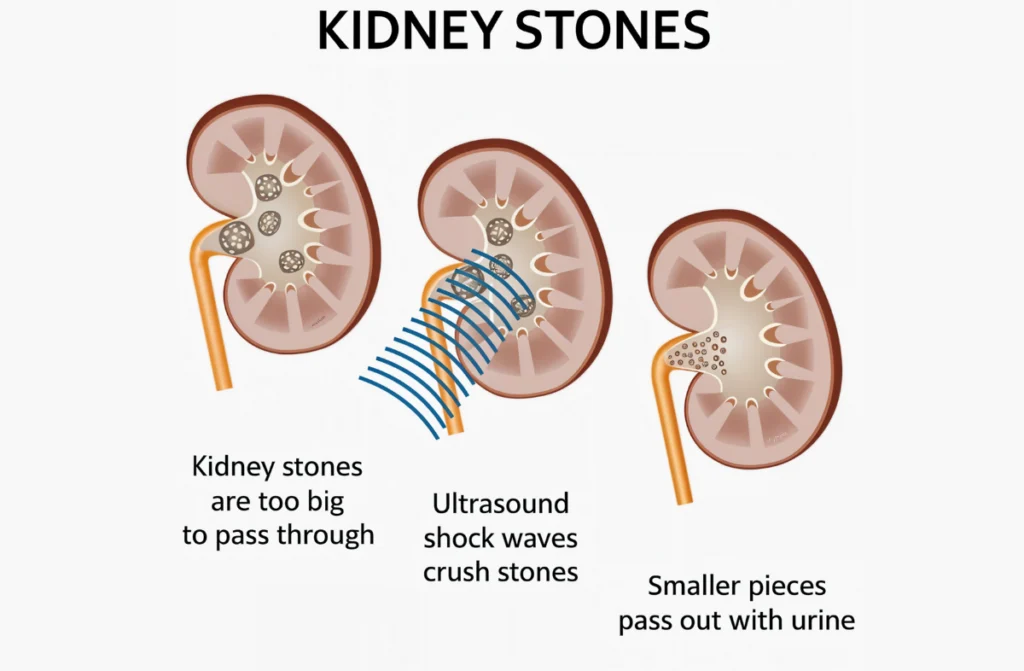 Kidney Stones Treatment In Chennai