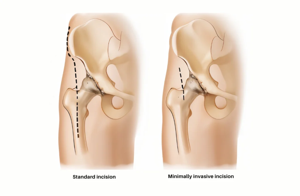 Minimally Invasive Hip Surgery in Chennai
