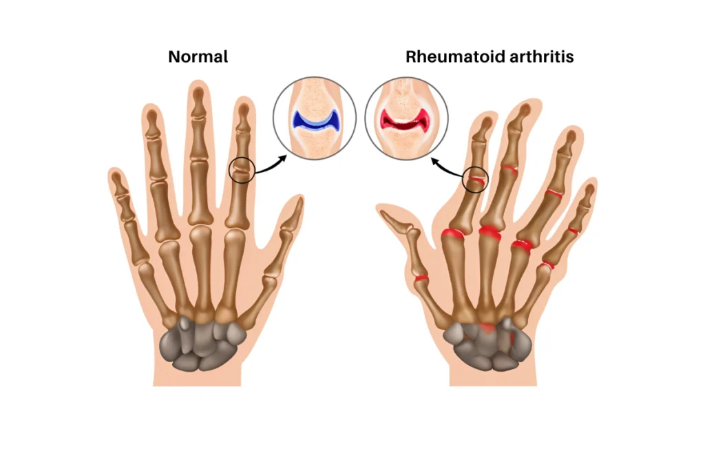 Rheumatology Specialist in Chennai