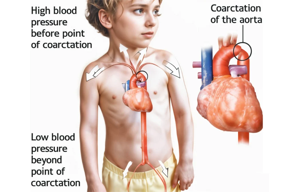 Coarctation of the Aorta Symptoms