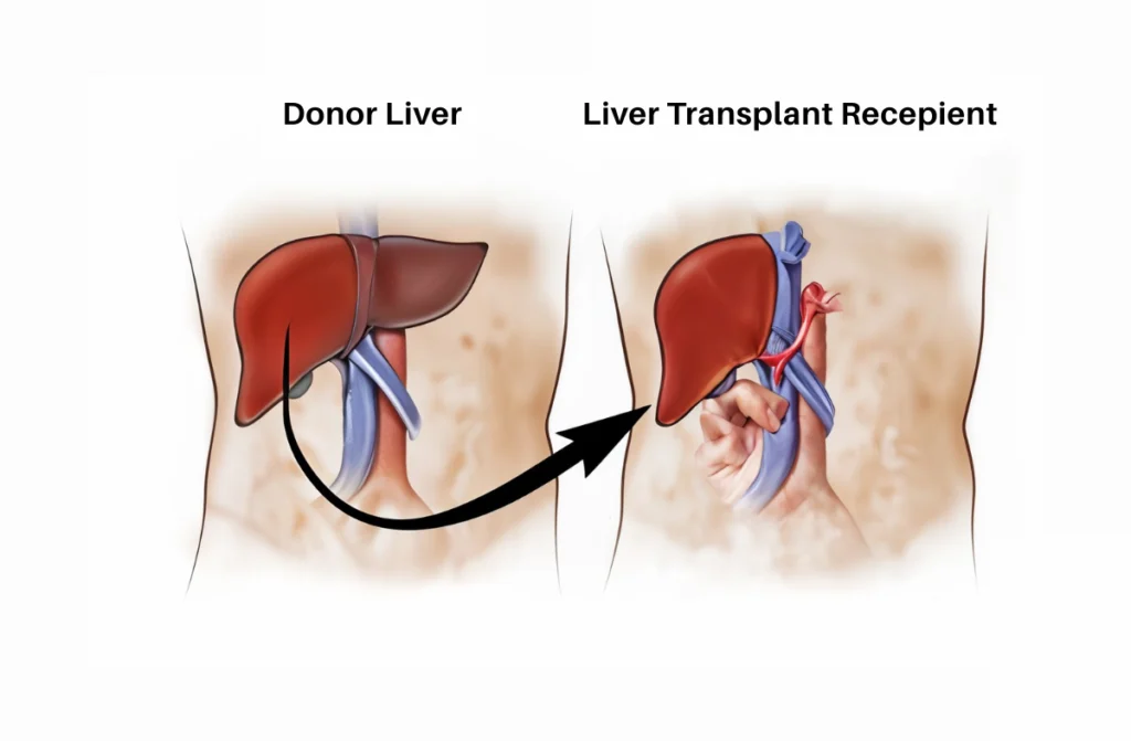 Best Liver Transplant Hospital in Chennai
