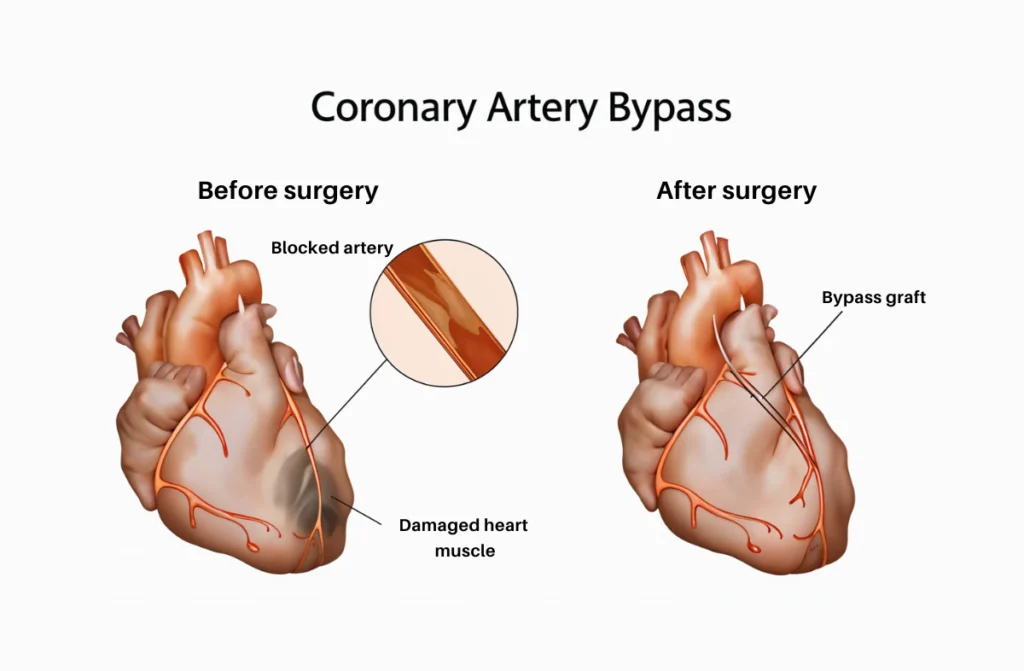 Coronary Artery Bypass Surgery