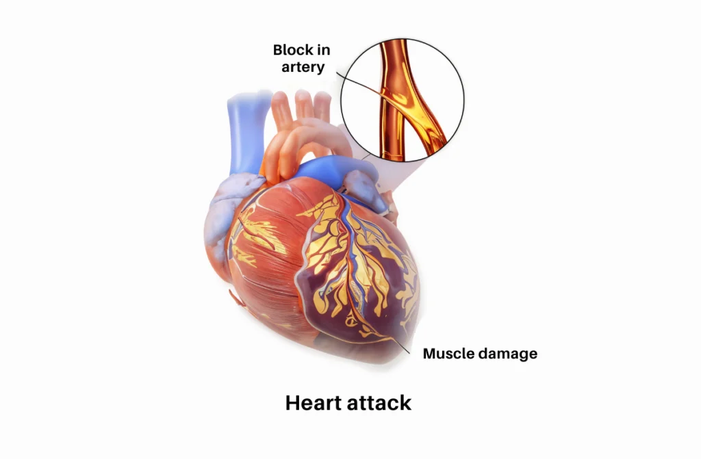 How to Control Heart Attack