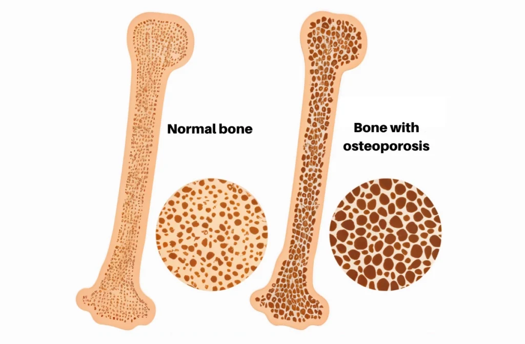 How to Improve Bone Health