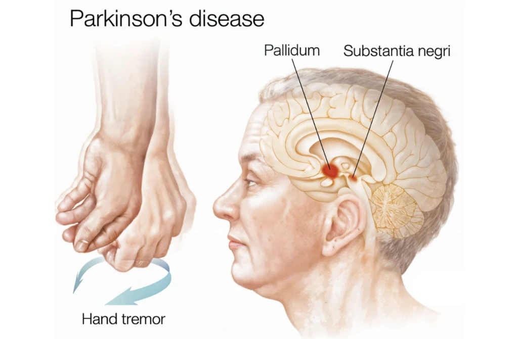 Parkinson’s Disease Treatment In Chennai