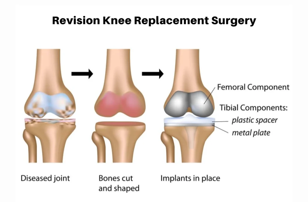 Revision Knee Replacement Surgery