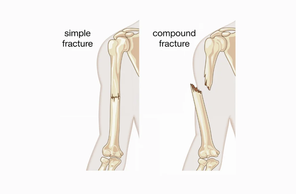 Fracture Treatment in Chennai