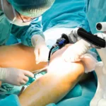 Robotic knee replacement in Chennai